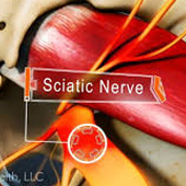 Sciatica